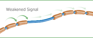 A damaged nerve with a broken down myelin layer as a result of MS A damaged nerve with a broken down myelin layer as a result of MS